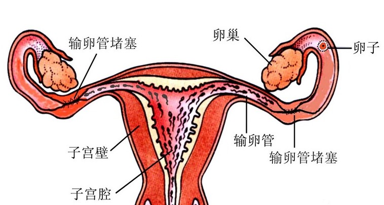 疏通输卵管会很痛吗.jpg