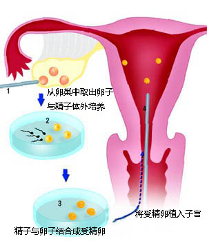 试管婴儿移植怎么做