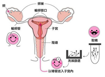 人工受精需要多少钱