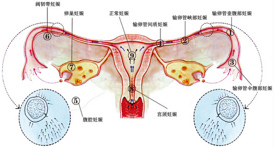 微创取胚术 长江开启宫外孕手术新模式